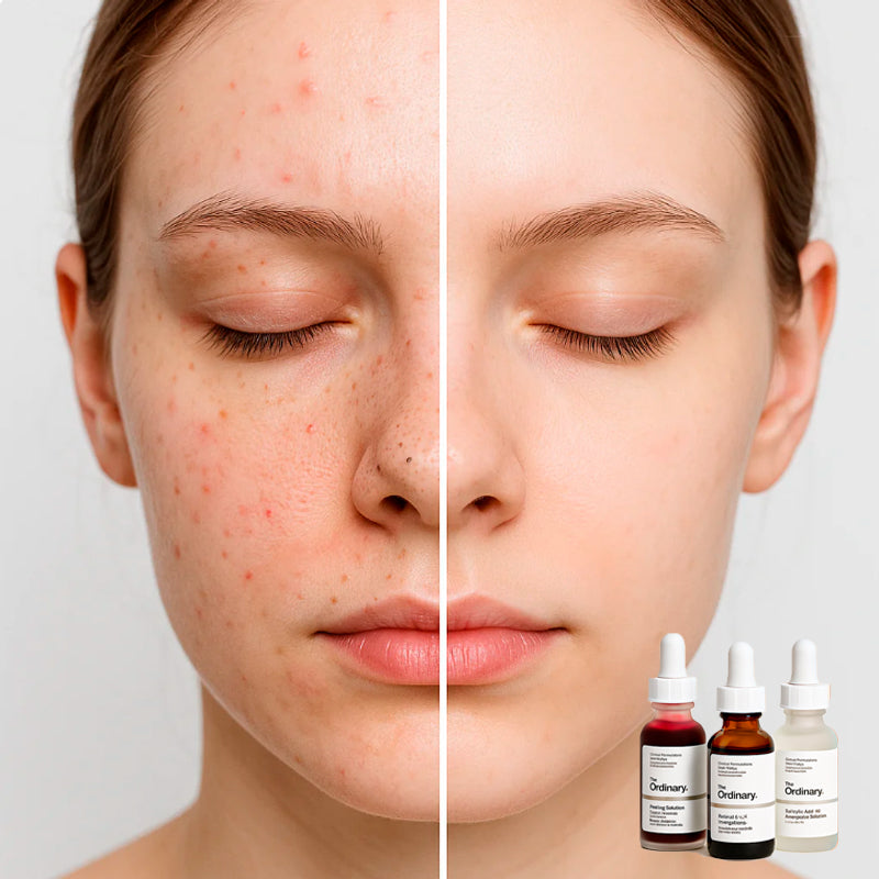 Combo The Ordinary | Anti Acné: Peeling + Retinol + Ácido Salicílico