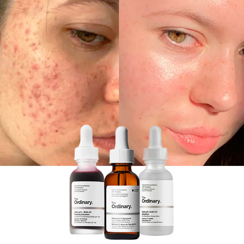 Combo The Ordinary | Anti Acné: Peeling + Retinol + Ácido Salicílico