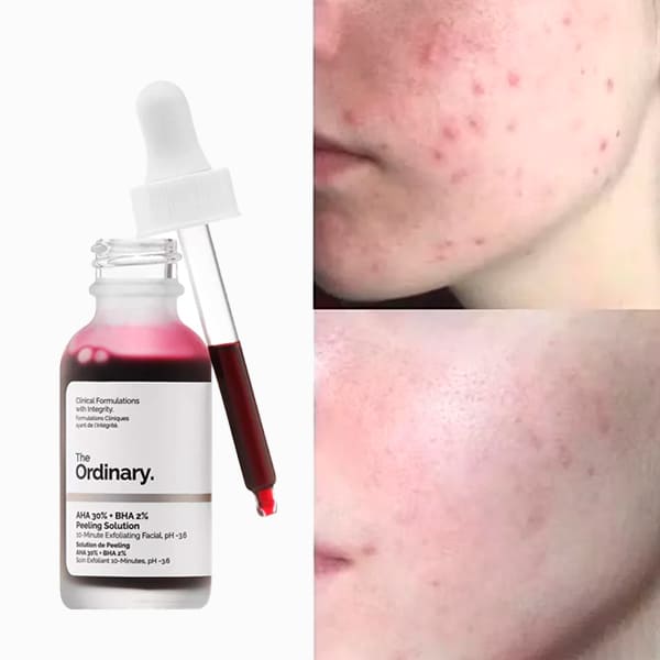 Peeling Solution AHA 30% + BHA 2% The Ordinary - Piel renovada