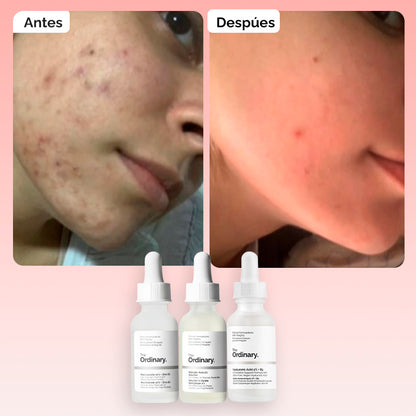Combo Trío Dermatológico Anti-Poros | Niacinamida + Acido Hialuronico + Acido Salicilico