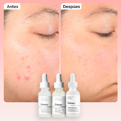 Combo Trío Dermatológico Anti-Poros | Niacinamida + Acido Hialuronico + Acido Salicilico